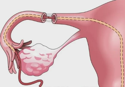 滁州单身供卵助孕：单侧输卵管结扎的这六个后果不仅会影响到生育能力，也会影响到身体健康。